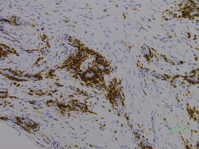 Bone marrow, CD117 IHC